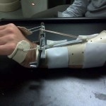 Dynamic Wrist Extension Splint