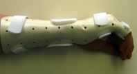 Ulnar Gutter Splint